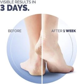 Scholl Klovenzalf - K+ Creme - Voor Hielkloven En Ruwe, Droge Huid -Verzorgingsproducten 1094x1200 1