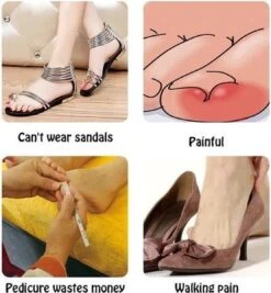 Merkloos Ingegroeide Teennagel Corrector 13 Merkloos Ingegroeide Teennagel Corrector -Verzorgingsproducten 1111x1200