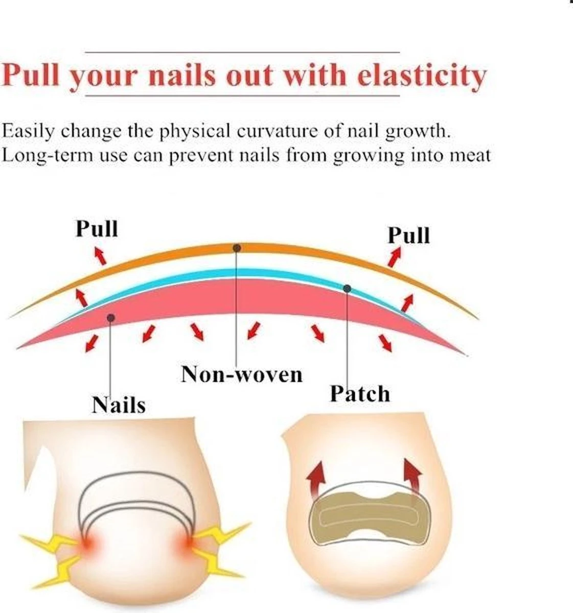 Merkloos Ingegroeide Teennagel Corrector 4 Merkloos Ingegroeide Teennagel Corrector - Afbeelding 2