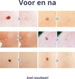 Steelwratjes Verwijderaar - Steelwratjes Verwijderen - Pijnloos En Snel - Wrattenverwijderaar - Steelwratten 11 Steelwratjes Verwijderaar - Steelwratjes Verwijderen - Pijnloos En Snel - Wrattenverwijderaar - Steelwratten -Verzorgingsproducten 1148x1200