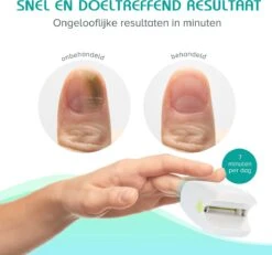 Anti Schimmelnagel Zelf-laserapparaat Incl. Pedicure Set -Verzorgingsproducten 1200x1120 1