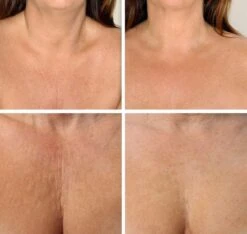 Simia™ Anti Rimpel Beauty Pads - Decolleté Large T Shape Set (2 Stuks) - Herbruikbaar Anti Aging Siliconen Pad Tegen Lijntjes En Slaaprimpels -Verzorgingsproducten 1200x1139 1