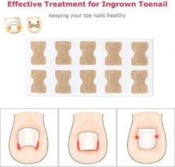 Merkloos Ingegroeide Teennagel Corrector 11 Merkloos Ingegroeide Teennagel Corrector -Verzorgingsproducten 1200x1146