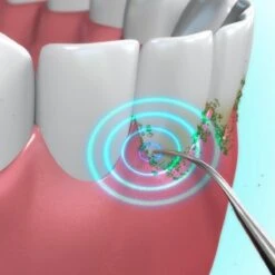 Toppers Van TV - Sonic Tandsteenverwijderaar - Tandplakverwijderaar -Verzorgingsproducten 1200x1200 1239