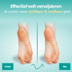 FreshDragon Elektrische Eelt Verwijderaar - Voetvijl - Inclusief 3 Rollers - Oplaadbaar -Verzorgingsproducten 1200x1200 129