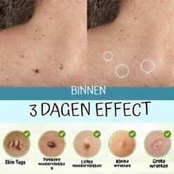 Skini™ - Moedervlekken & Wratten & Skin Tags Verwijderaar | Moedervlekken Verwijderaar | Wratten Verwijderaar | Moedervlekken Verwijderen | Wratten Verwijderen | Fibroom Verwijderen | Skin Tag Verwijderen | Steelwratjes Verwijderen -Verzorgingsproducten 1200x1200 414
