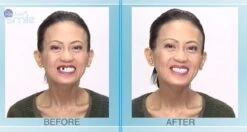 Tand Afgebroken Reparatie Kit InstantSmile Gebit (goedkope Kunstgebit) - Multi Shade -Verzorgingsproducten 1200x639