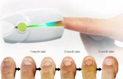 Anti Schimmelnagel Kalknagel Laserapparaat Om Zelf Te Behandelen, Veilig, Effectief, Snel En Pijnloos, Koude Laser Behandeling Voor Thuisgebruik, Voor Tenen En Vingers. Oplaadbaar. -Verzorgingsproducten 1200x774